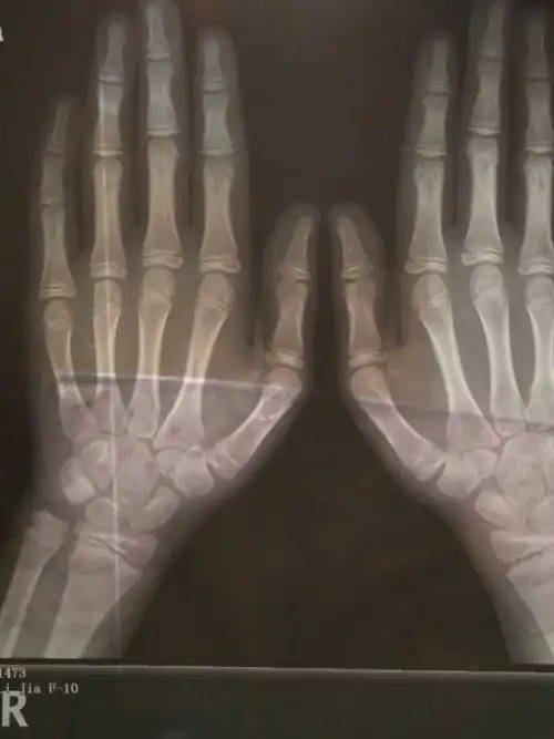 8基数据预测未来身高155至161.由于孩子生长激素峰值是6.