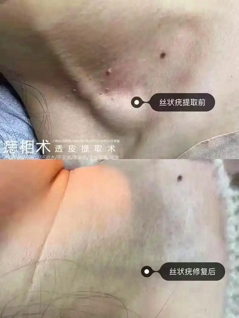 丝状疣好发于眼睑,颈部等处,为单个细软的丝状突起.是皮肤表面 - 抖音