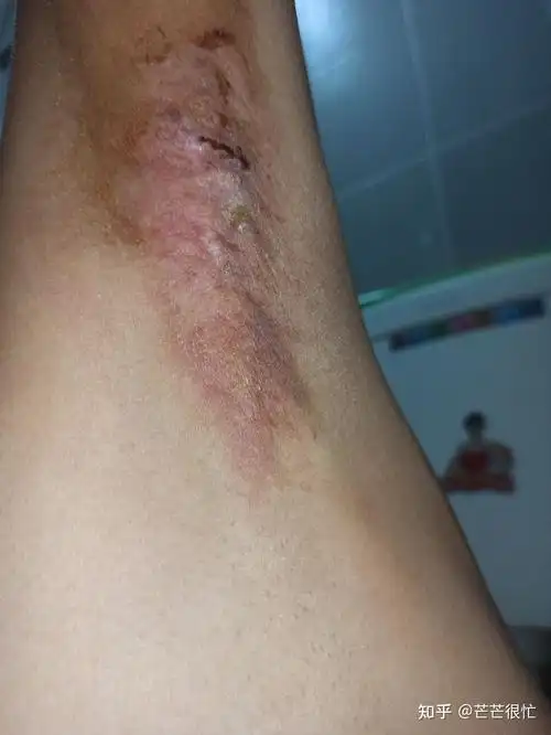 腋下微创手术记录