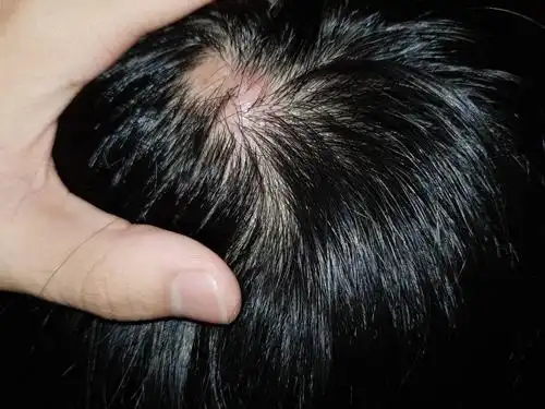 头上长痘痘 好疼 如何根治?