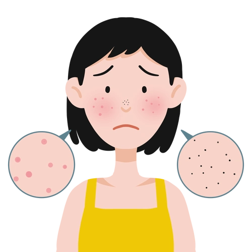 郑州皮肤病专科医院痤疮对患者的皮肤造成了哪些危害呢