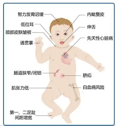 科普重视唐氏筛查孕育健康宝宝孕妈妈的唐氏综合征6连问
