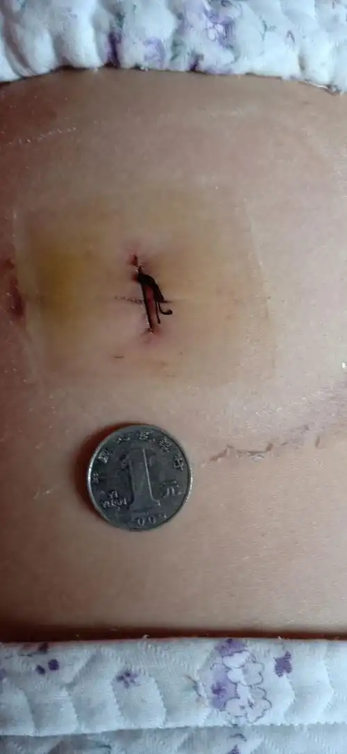 术后随访,伤口不到一厘米,比硬币还要小得多