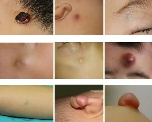 科普知识 什么是钙化上皮瘤(毛母质瘤),孩子长了钙化上皮瘤如何处理