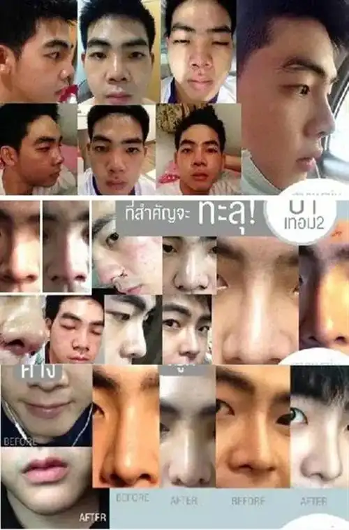 小哥花74万整容从丑男变网红