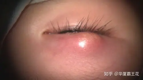 7人赞同了该文章 小陈说,一觉醒来,眼皮突然很疼,还磨得不行,拍了一