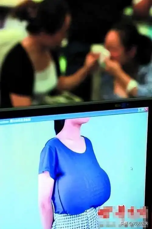 好处就是几乎是一次就能将胸部过大,和胸部下垂的问题解决,而吸脂手术