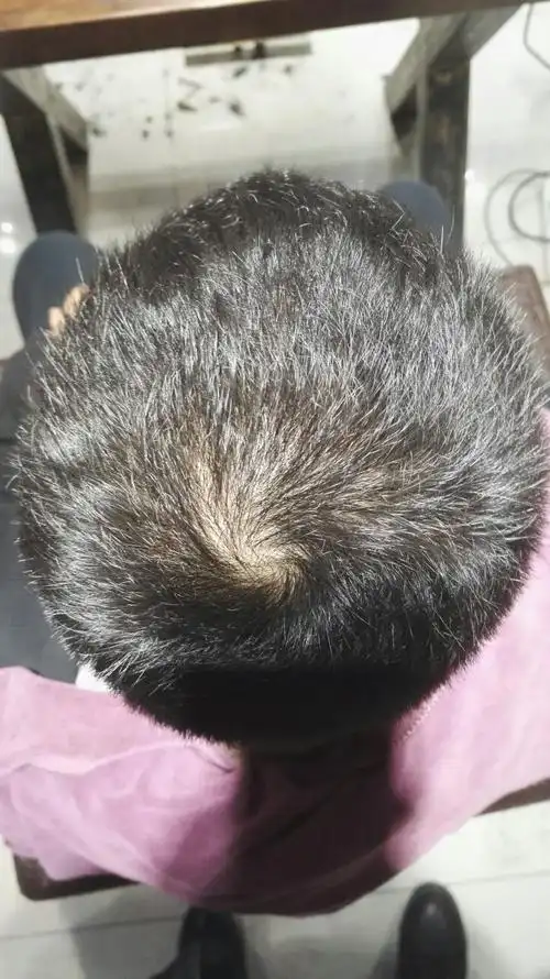 最近一年里掉头发很严重,每次洗头都掉二十根左右,有可能是肾虚导致的