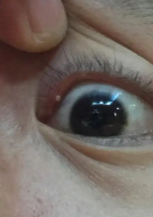 眼皮里起了个白色颗粒点是什么东西?