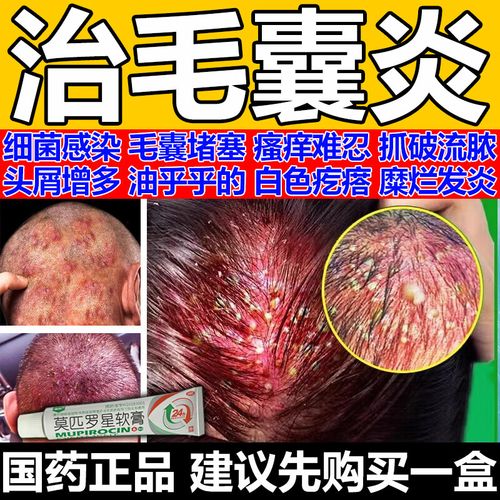 莫匹罗星软膏 头皮毛囊炎头部长疙瘩脓包毛囊炎头部专用效药大块头皮