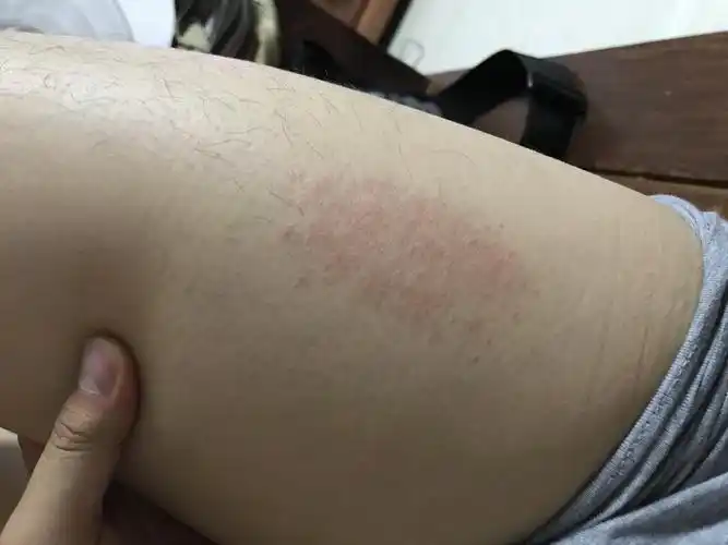 大腿上突然出现一片红