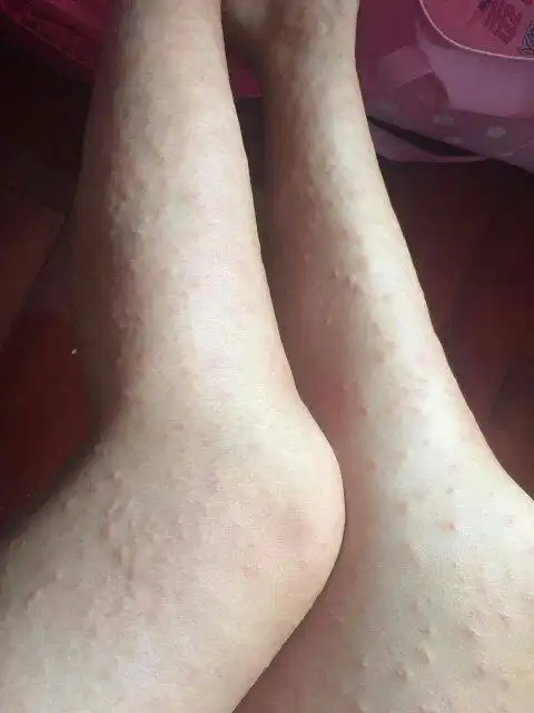 请问,我坐月10天,全身痒