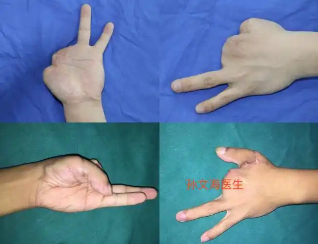 拇手指再造附案例集