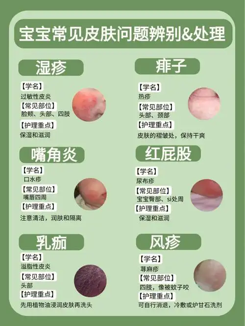 宝宝皮肤问题应对大全如何区分湿疹痱子63