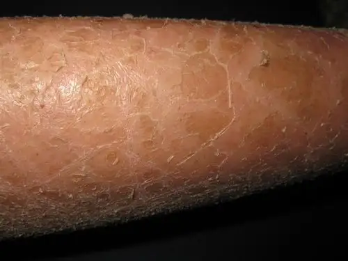 看图识病----------鱼鳞病 - 皮肤及性传播疾病讨论版 - 爱爱医医学