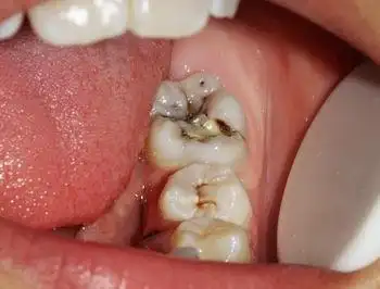 牙痛的原因是什么