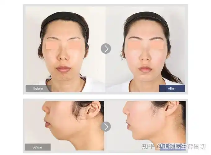 颏成型手术和外科正颌手术有什么区别哪个风险大