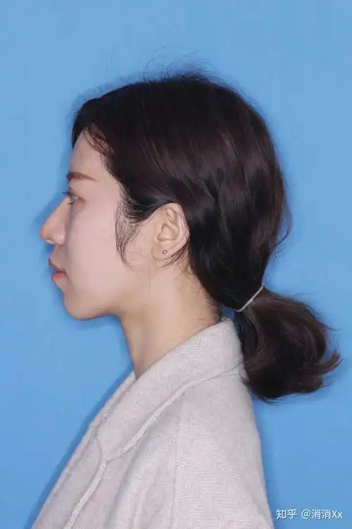 怎么让凸嘴不明显?