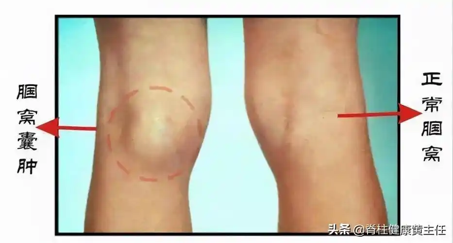 什么是膝关节囊肿