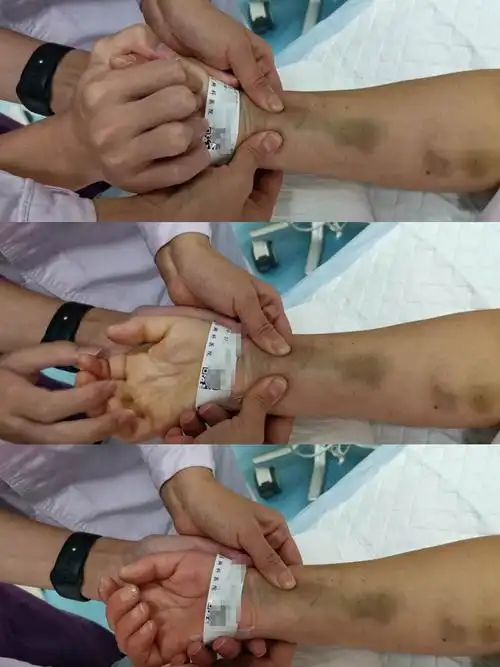 必不可少的术前评估,术前评估患者穿刺部位皮肤情况及allen实验