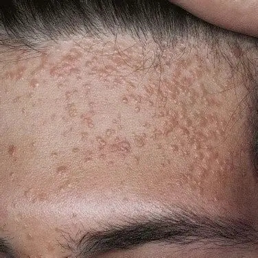 面部泛发性扁平疣的治疗