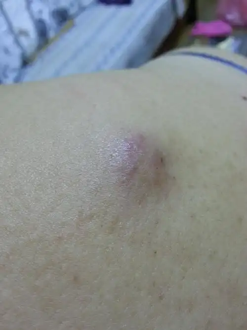 后肩膀长了一个包,开始很小,现在有一个1元硬币大小,很硬,现