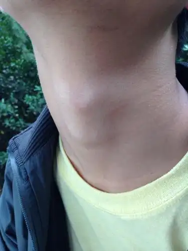 本人男,喉结有两个,有图 然后说话,舌根音发不清楚,说话声音比较尖