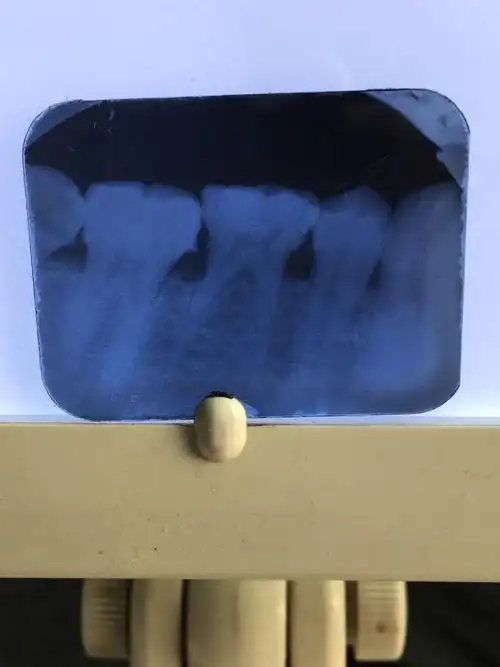 先天性下合第二双尖牙缺失