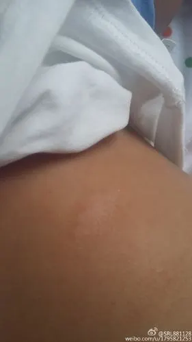 孩子身上像癣一样的是什么?怎么治疗?|鲍秀兰|湿疹_新浪育儿_新浪网