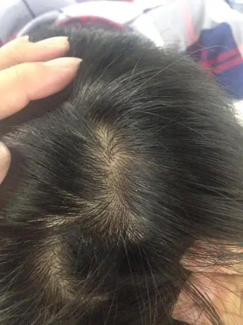 头皮发痒,特别痒,只是痒.有些地方发红