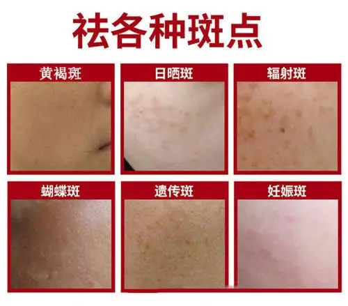 面部激光后要注意什么,面部激光祛斑后多久可以恢复?