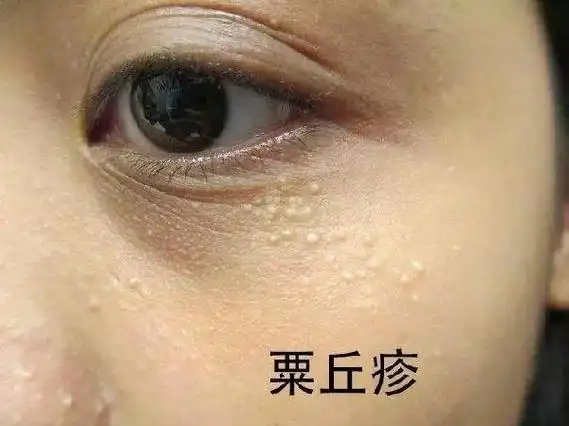 眼部最近老长脂肪粒