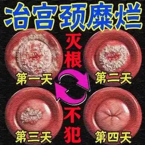 治疗宫颈糜烂的药妇科凝胶消糜栓重度阴道炎白带异味宫颈肥大用药