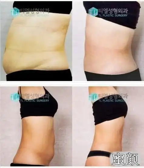 抽脂效果           提取的脂肪,也叫自体金,可以注射到缺乏自体