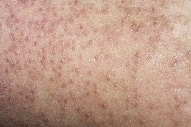 后背皮肤鸡皮图片(后背皮肤很粗糙,像鸡皮)