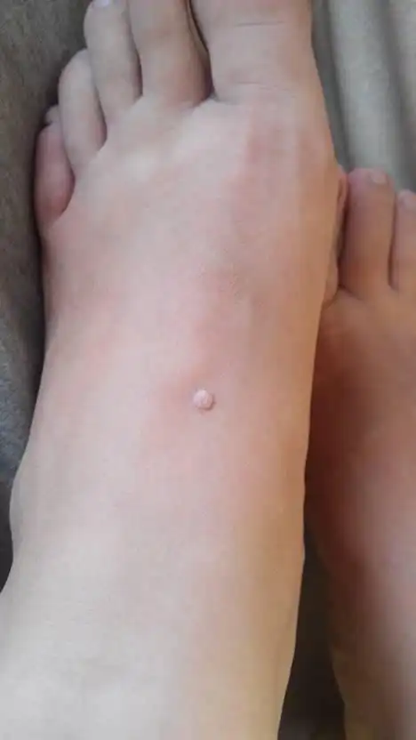 脚上莫名其妙的长了这个,肉肉的.不知道是什么东西,求治疗方法.