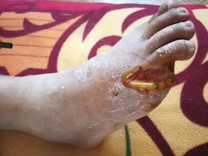 新技术 | 孝义市人民医院骨科开展胫骨横向骨搬移术让患者避免了截肢