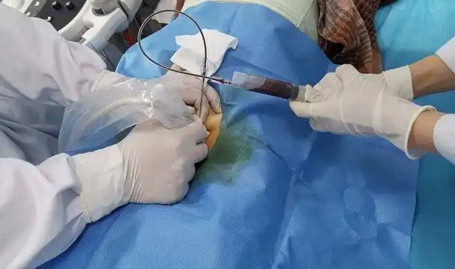 穿刺|乳腺|肿瘤|囊肿|活检_网易订阅