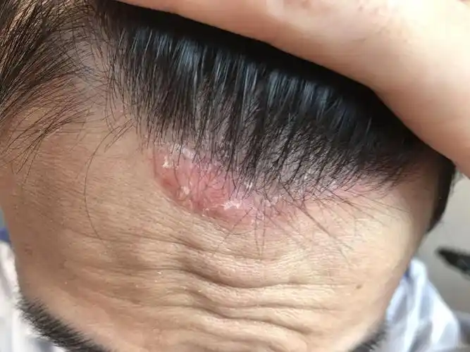 头皮问题 瘙痒掉屑