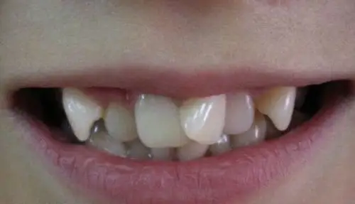 广州虎牙牙齿正畸