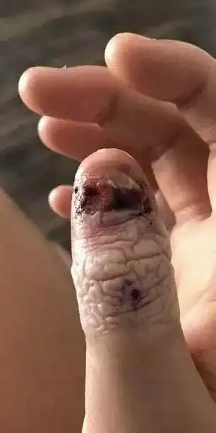 女大学生一紧张就"咬指甲",咬着咬着就麻木了,最后被截肢
