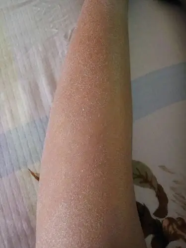 不知怎么的,腿上起干皮了.也不知道是不是鱼鳞病.