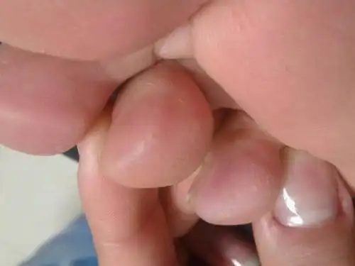 脚趾上长出来好多透明的硬硬的小疙瘩,嘛情况,求告知啊