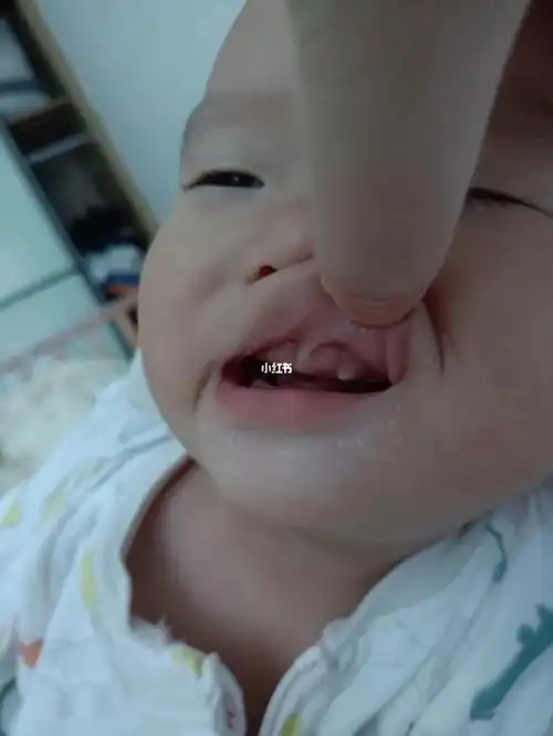 为什么宝宝先长虎牙