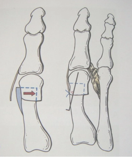 骨科精读 | 手把手教程:拇外翻治疗策略与最优术式选择!