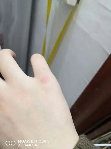 手被暖光灯烫伤了,难受