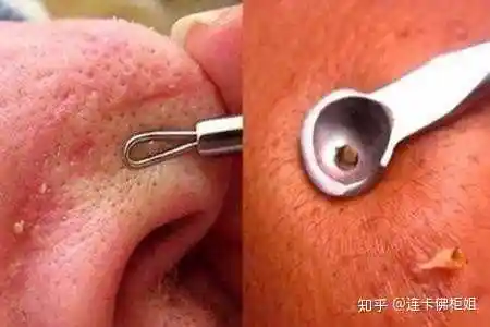 鼻子上和脸颊上黑头闭口粉刺多,怎么才能根除?