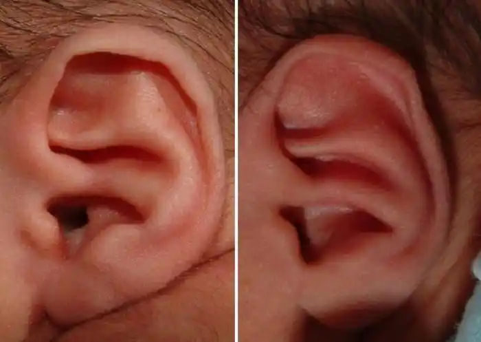 stahls耳表现为对耳轮上脚变浅或消失,耳廓后上方异常突出,以形成第3