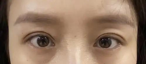 双眼皮闭眼太肉条06想修复01姐妹们帮忙看看01