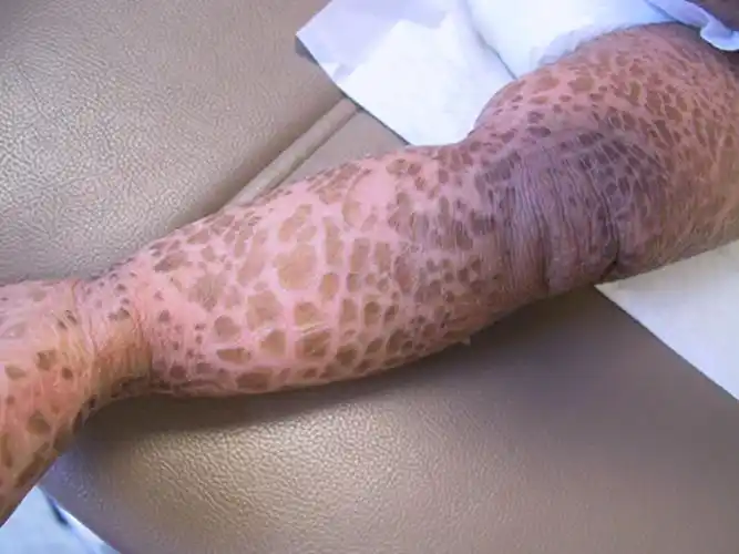 角样鱼鳞病图片_有来医生